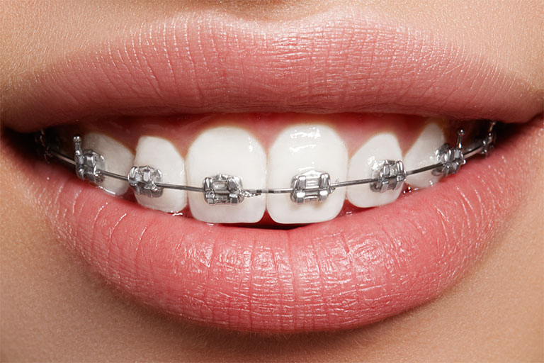 Brackets metálicos