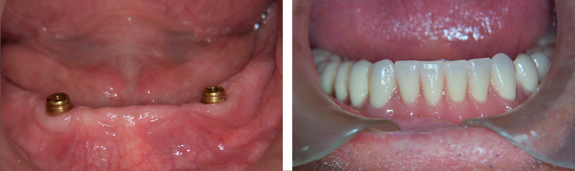 Implant Locator