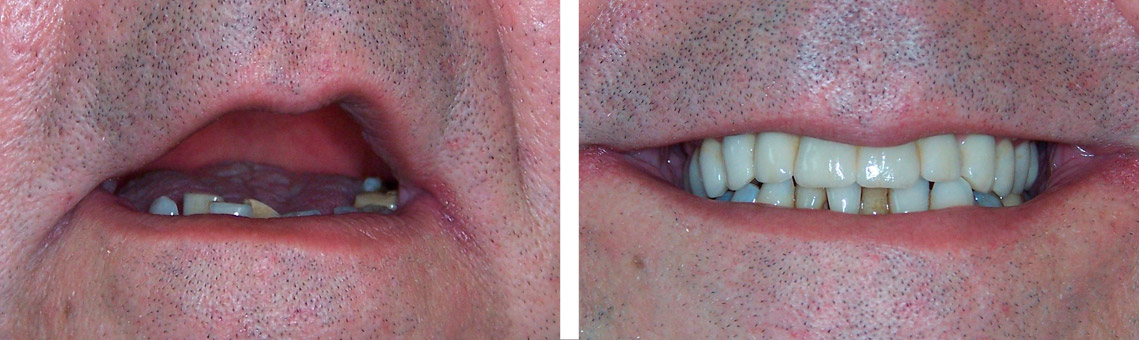 Rehabilitación implantes 2