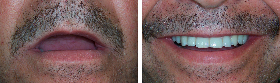 Rehabilitación implantes 4