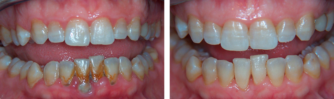 Tratamiento periodoncia