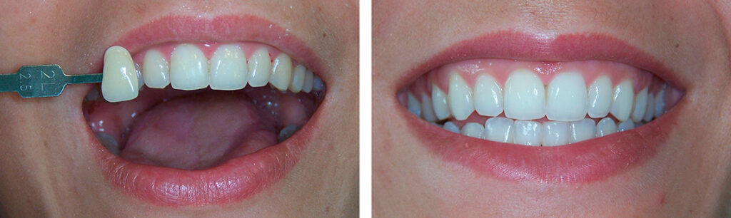 blanqueamiento-clinica-dental-diez-marieges
