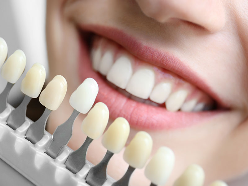 Blanquejament dental