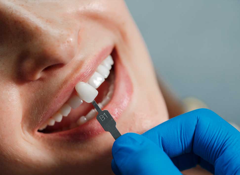 carillas-ceramica-clinica-dental-barcelona