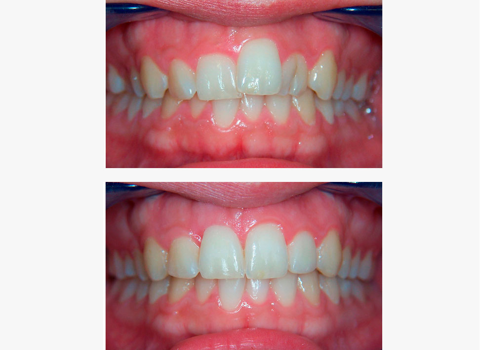 Malposición dentaria caso clínico