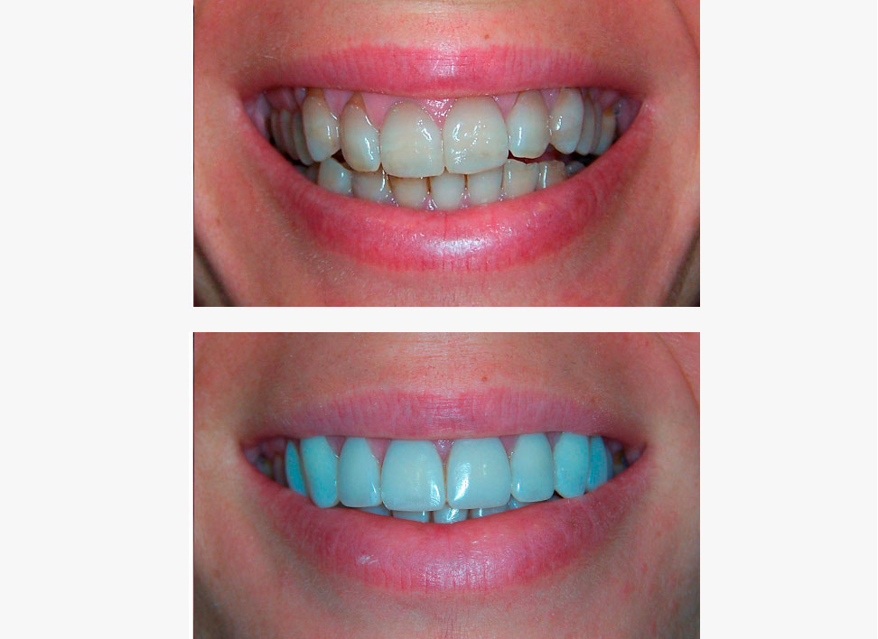 Caso complejo estética gingival