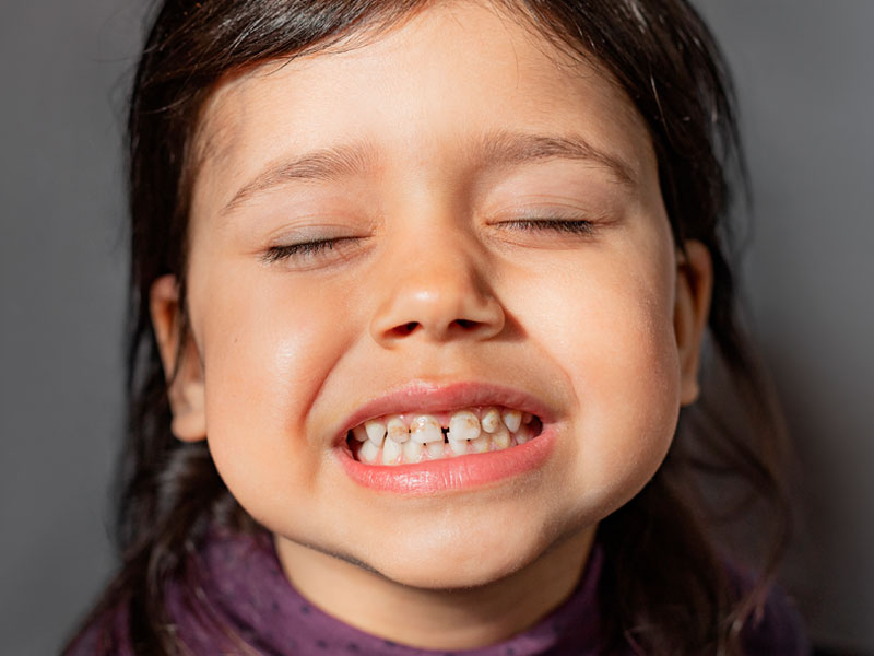 causas-oscurecimiento-dental-intrinsecas