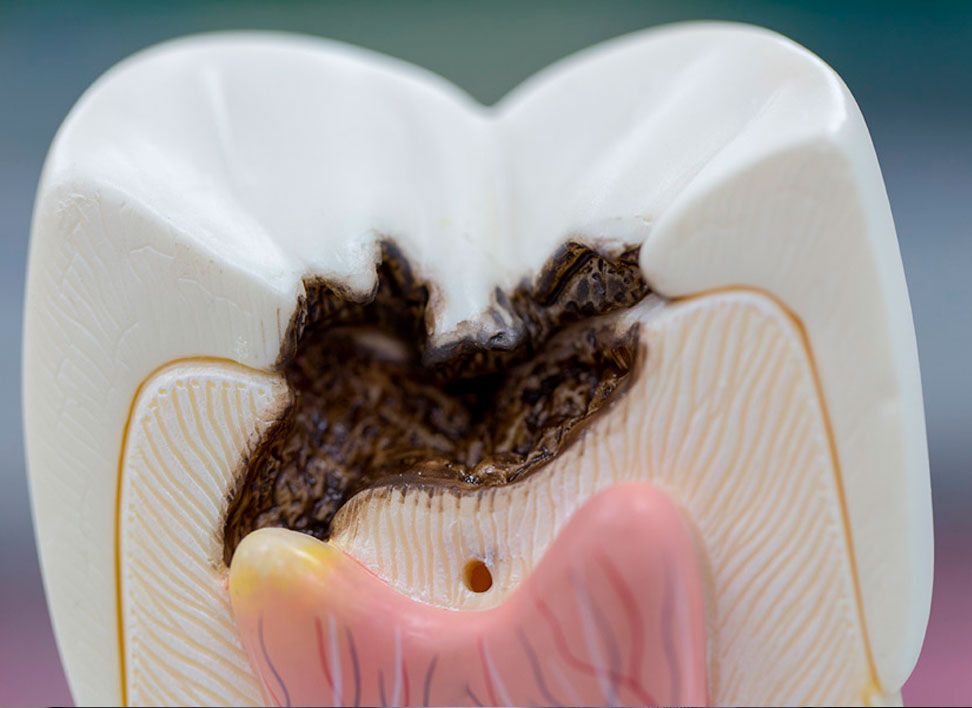 endodoncia