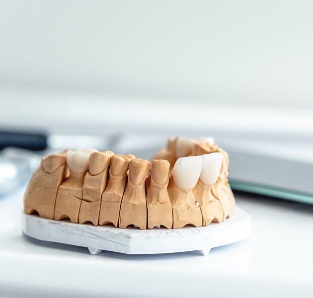 indicaciones-carillas-lumineers-clinica-dental-barcelona