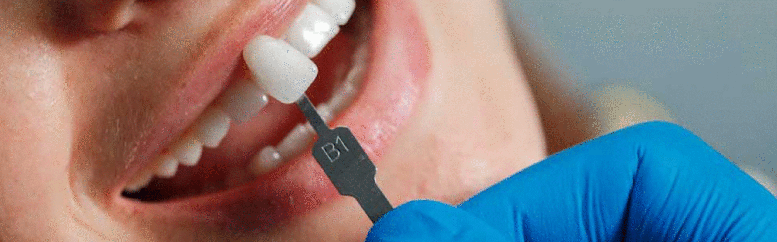 carillas-ceramica-clinica-dental-diez-marieges
